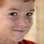 Photo of a boy with chickenpox