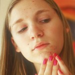 Photo of a young women with acne