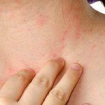 Photo of a woman's neck with hives