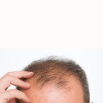 photo of a man with male pattern baldness