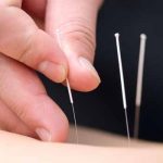 photo of acupuncture